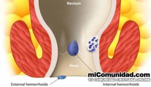 Cómo curar las hemorroides con remedios caseros