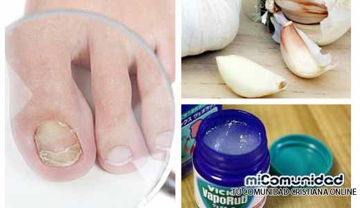 7 remedios caseros para combatir los hongos en las uñas de los pies y manos