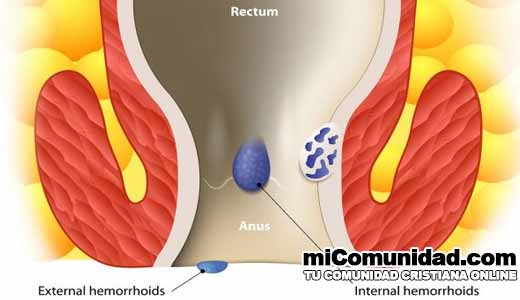Cómo curar las hemorroides con remedios caseros