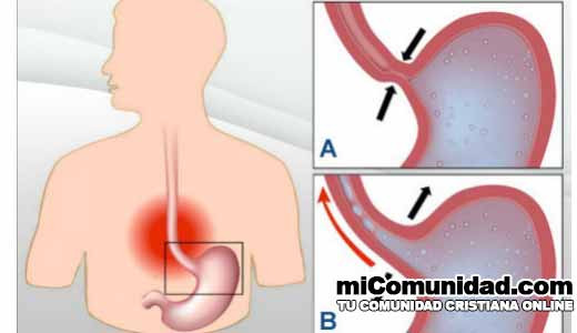 7 Remedios naturales para tratar la acidez y el reflujo ácido