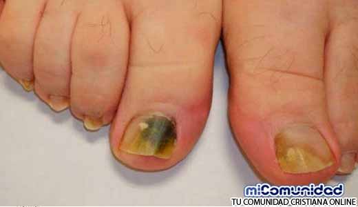 A esto le llaman el “Rompe Hongos” porque elimina todos los hongos de las uñas de una….